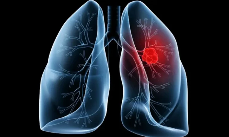 cancer-de-pulmao